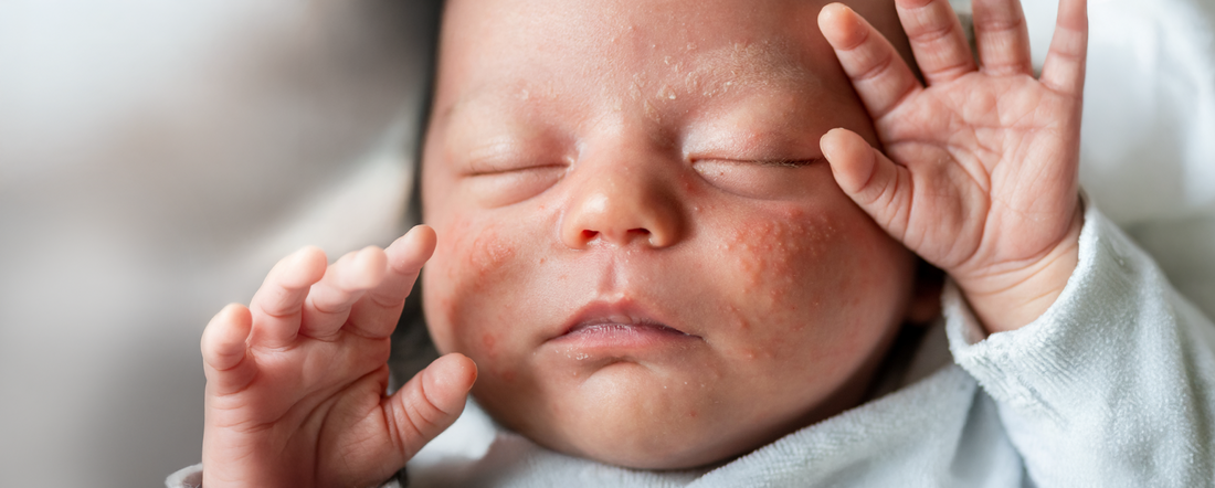 Soothe Baby Eczema with Baby sebamed
