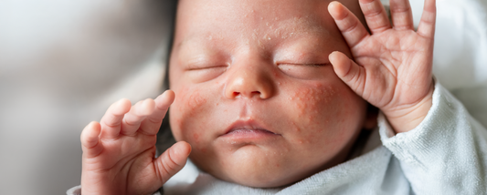 Soothe Baby Eczema with Baby sebamed