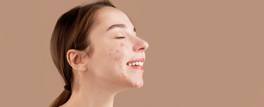 Skin Care Myth Busting: Acne