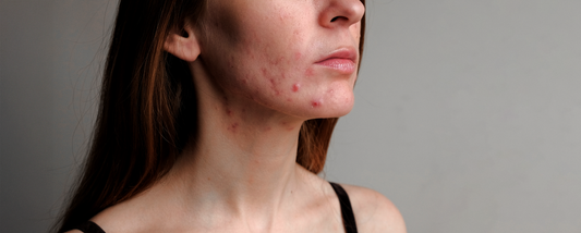Skin Care Myth Busting: Acne