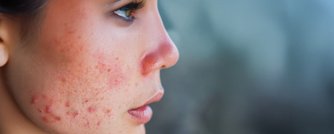 Acne Guide: Tackling Acne At Any Age