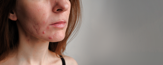 Acne Guide: Tackling Acne At Any Age