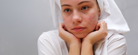 How Hormones Affect the Skin