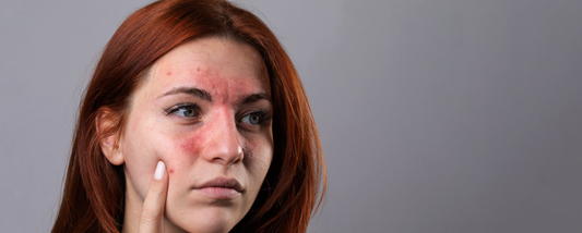 Skin Care Myth Busting: Eczema