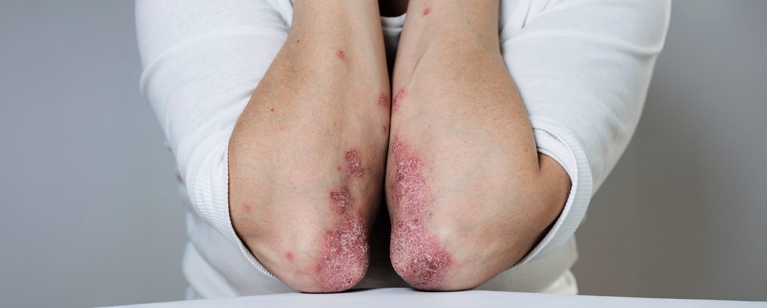 Managing Psoriasis: Gentle Skincare Solutions with sebamed