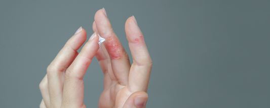 Understanding and Managing Eczema: How sebamed can soothe and protect sensitive skin