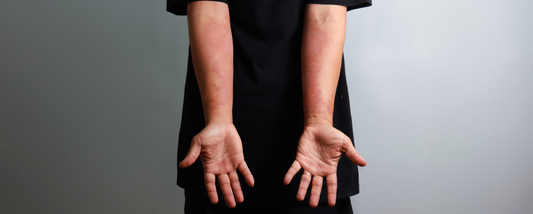 Understanding Dermatitis: Causes, Types and sebamed's Dermatologist-Recommended Solutions