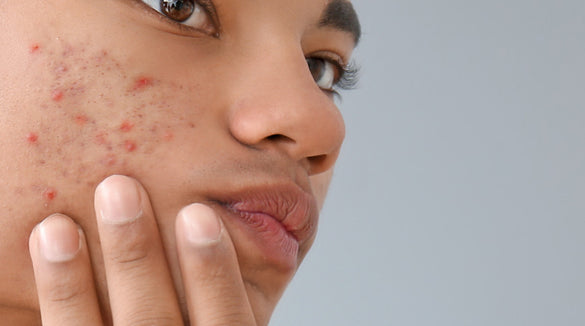 Acne-Prone Skin