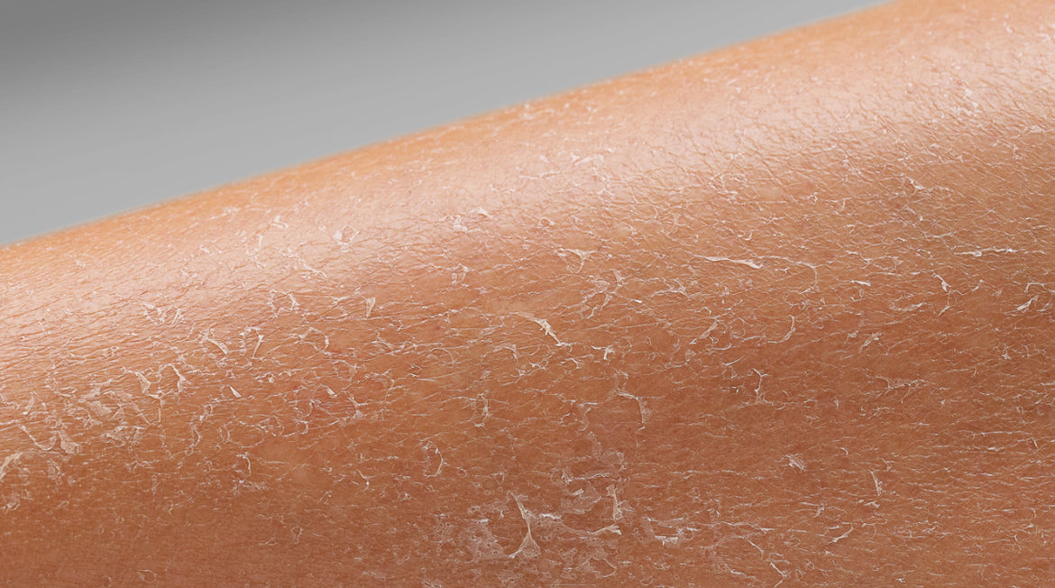 Dry Skin