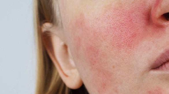 Redness and rosacea
