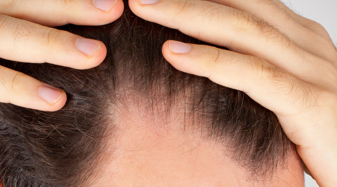 Hairloss